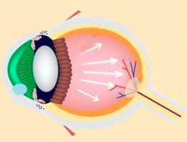 ¿Qué es la Glaucoma?
